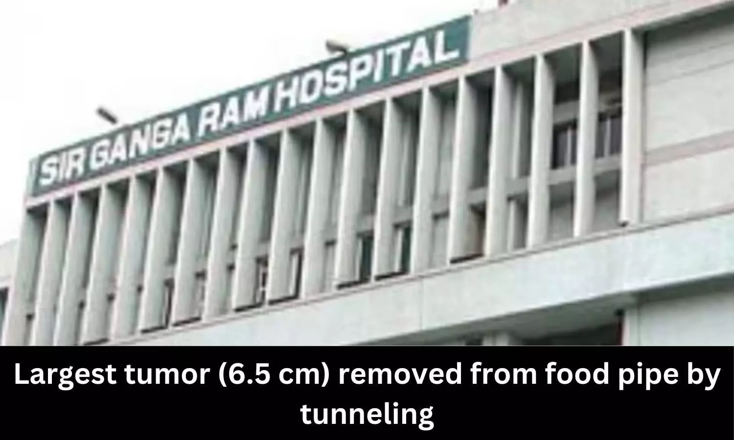 Large tumour removed from mans food pipe at Sir Gangaram Hospital