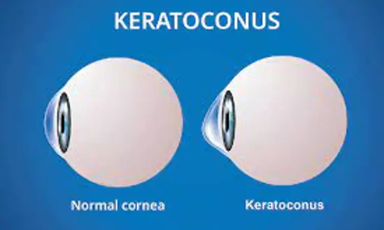 Keratoconus specific IOL formulas may lower refractive mean numerical errors in patients with keratoconus after cataract surgery