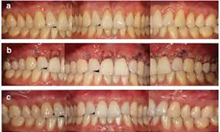 Tunnel approach without vestibular incision provides better esthetic outcomes in gingival recessions