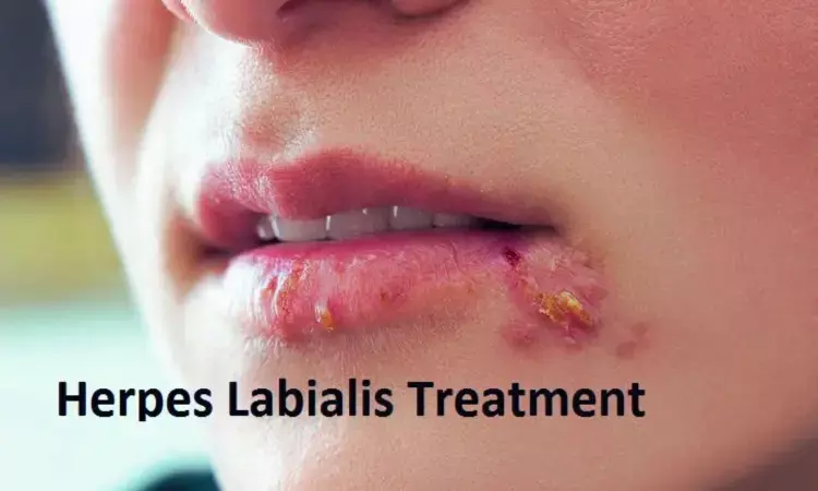 Combo therapy of oral valacyclovir with topical clobetasol best for managing herpes labialis
