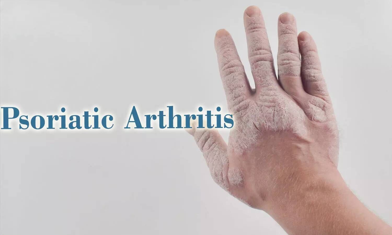 Brepocitinib Shows Promising Results In Patients With Psoriatic Arthritis