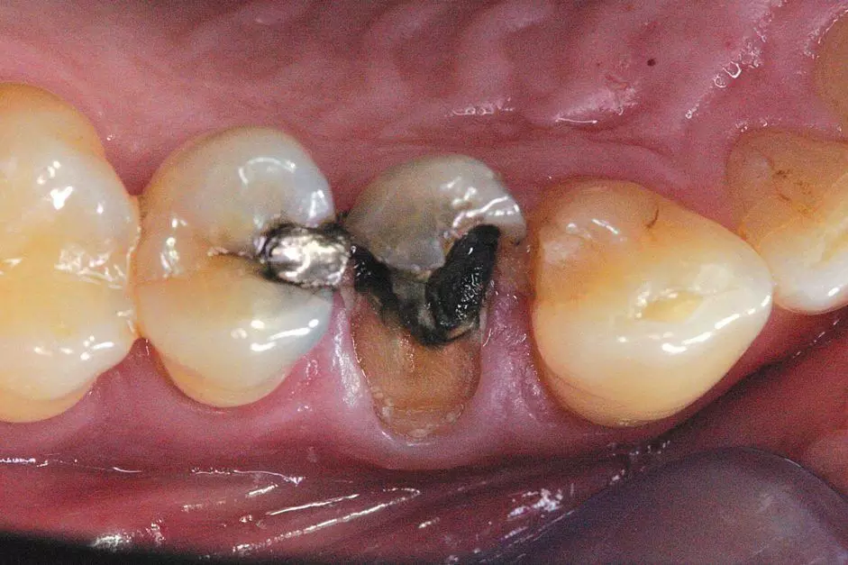 Close to 9% of Teeth That Receive Large Restorations Might End Up With Pulpal Disease