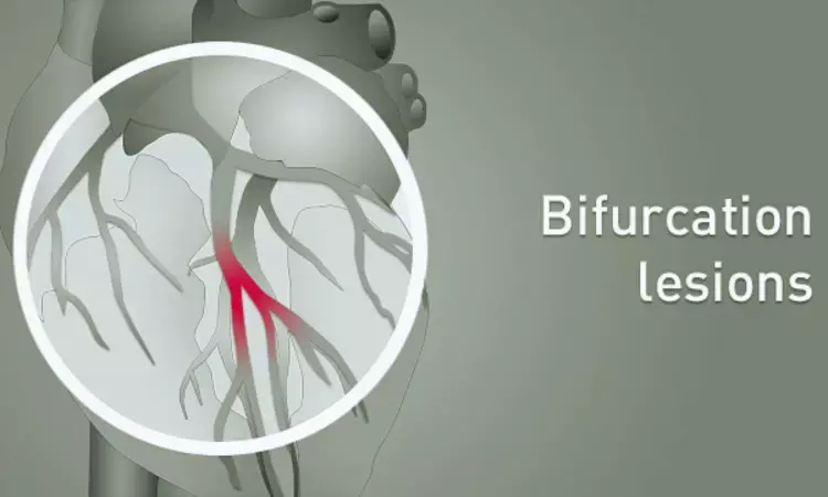 Its  okay to Start with just one stent for bifurcation lesions: EBC Trials