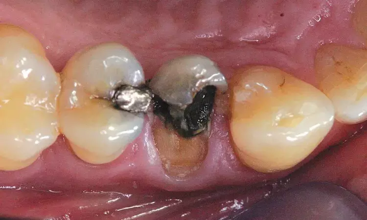 Close to 9% of Teeth That Receive Large Restorations Might End Up With Pulpal Disease