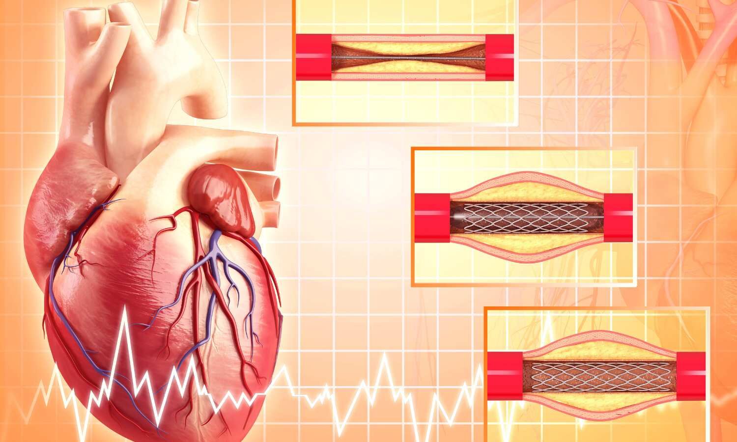 Selective Coronary Thrombectomy: CRM, June 2025 Study Finds No Increased Stroke Risk in High-Thrombus STEMI
