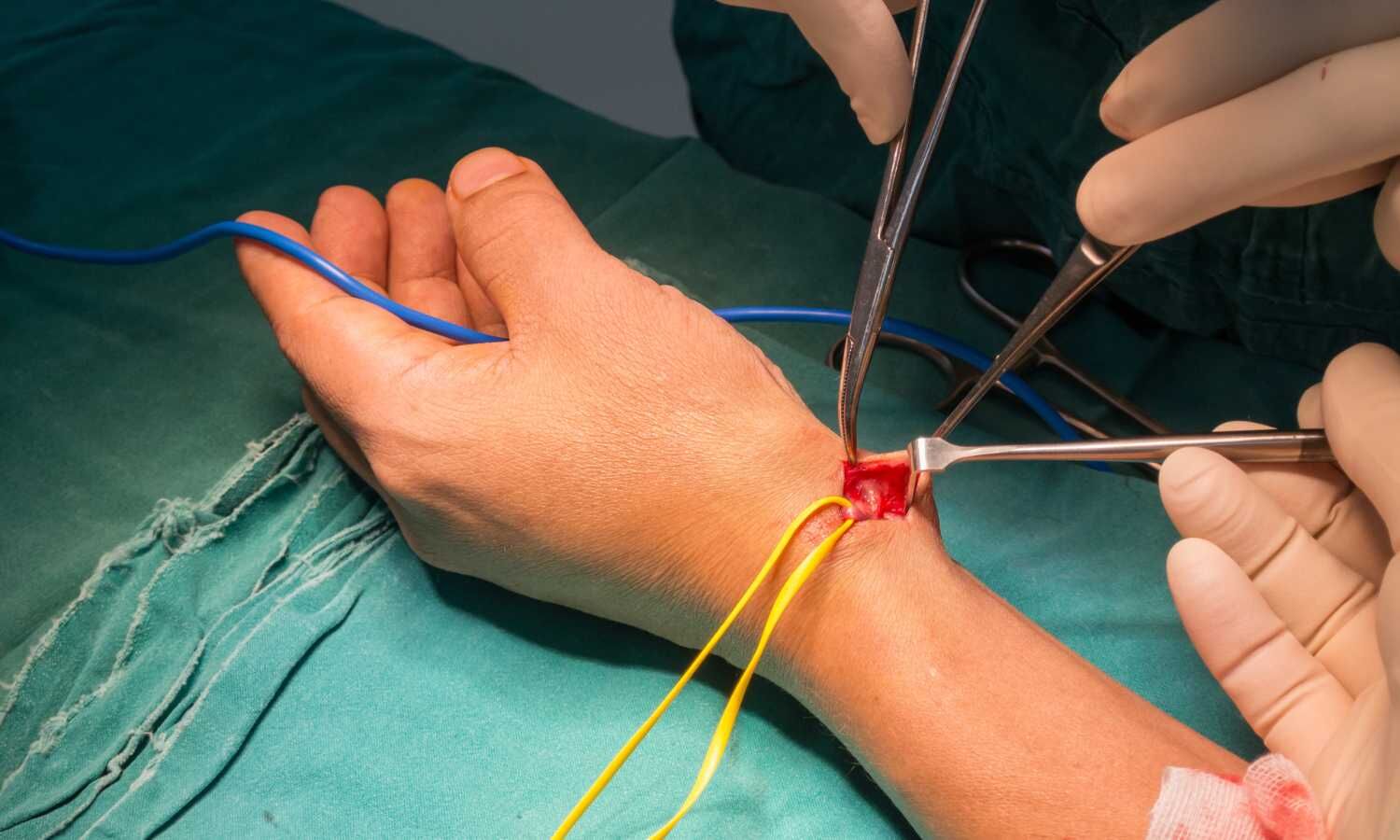 Flow within radial artery remains unchanged after cannulation among ...