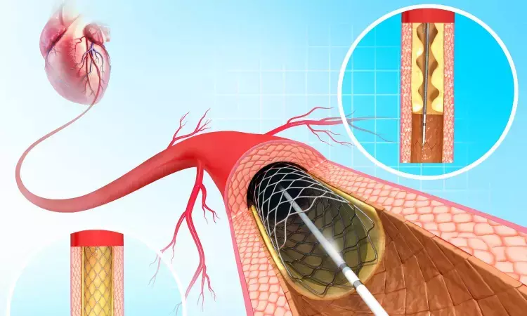 OCT guided PCI had less stent thrombosis compared to angiography-guided PCI