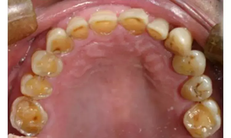 Gastroesophageal reflux disease associated with erosive tooth wear