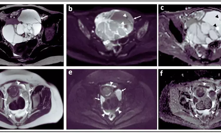 DWI-MRI helpful for pre-operative evaluation of patients with ovarian cancer