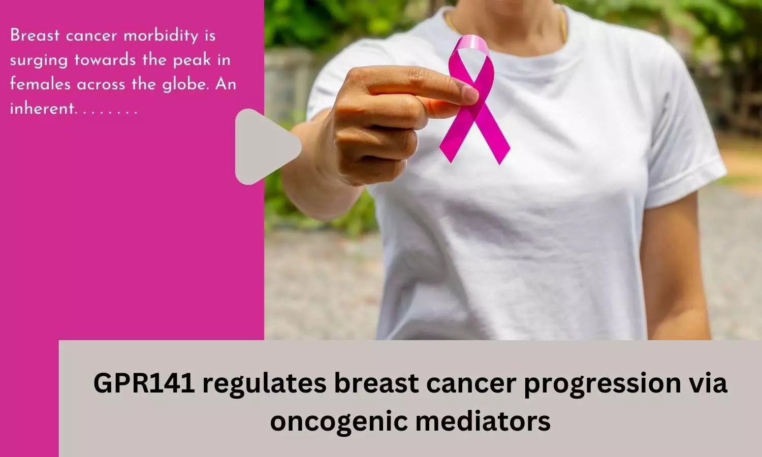 GPR141 regulates breast cancer progression via oncogenic mediators