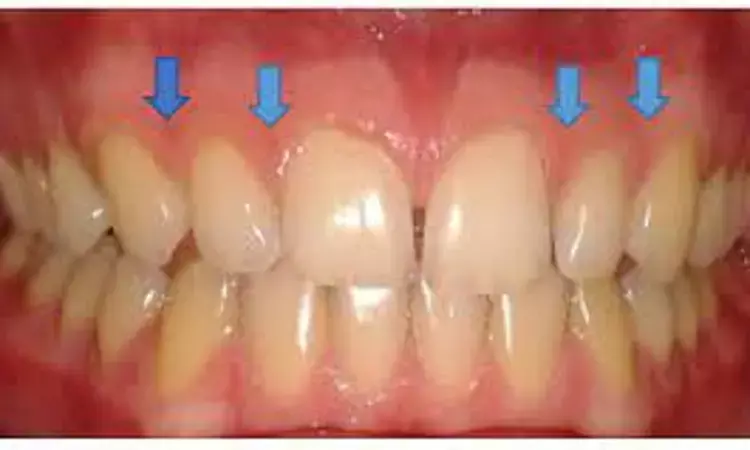 AI may identify specific sites with and without gingival inflammation as accurately as visua examination by  human