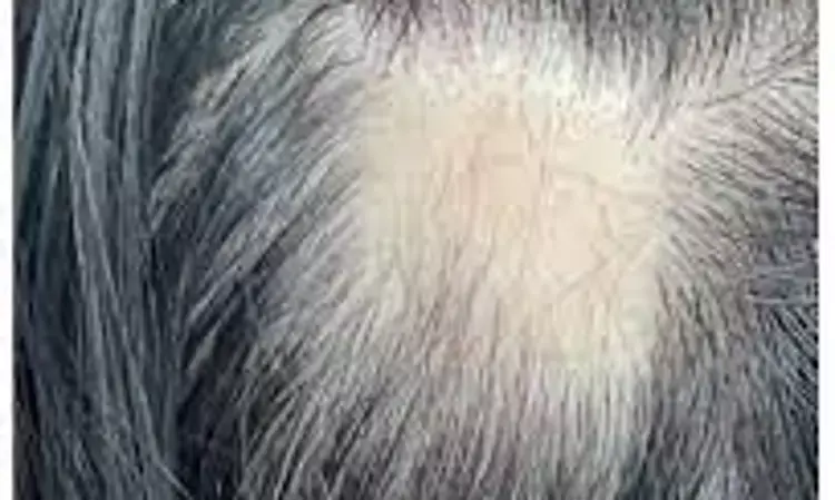 Maternal Alopecia  Areata associated with autoimmune, atopic, thyroid, and psychiatric disorders in offsprings:JAMA