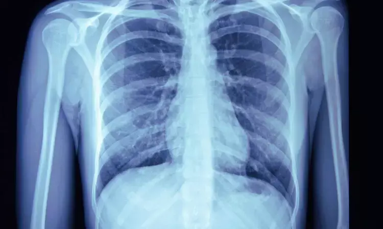 Deep learning model can identify lung cancer mortality on chest X-rays: Study