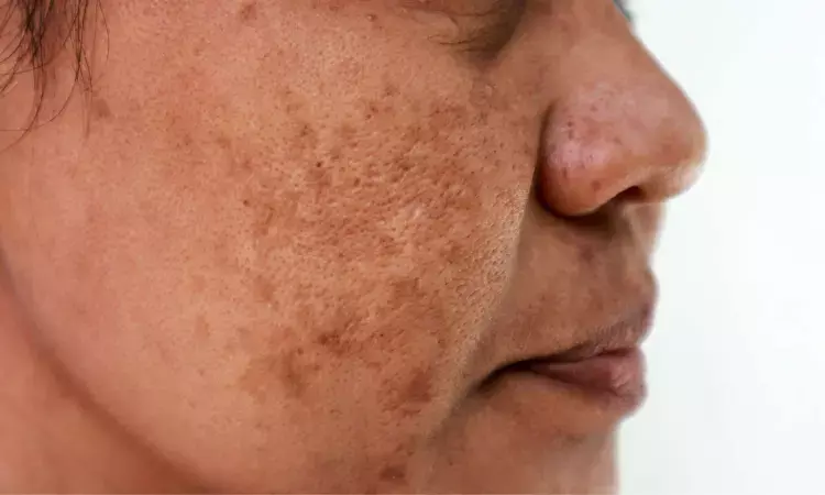 Breakthrough in Melasma Treatment: Q-switched Nd:YAG Laser Emerges as Top Choice