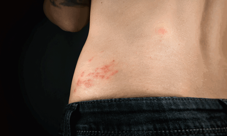 Patients with AD at elevated risk of herpes zoster infection