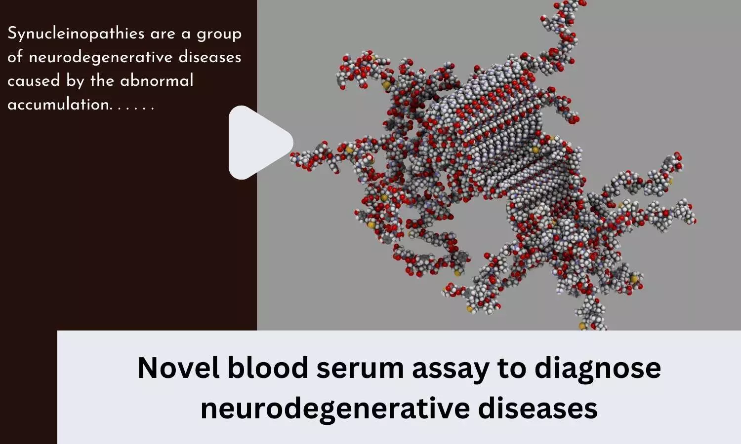 Novel blood serum assay to diagnose neurodegenerative diseases