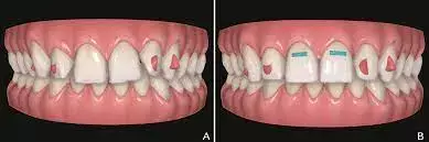 Prerestorarive short-term clear aligner therapy conserves tooth structure and reduce number of restoration