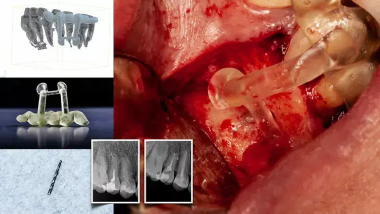 Dynamic navigation may linked to clinical accuracy and success in endodontic microsurgery