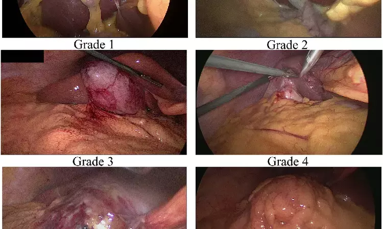 Parkland Grading Scale may accurately assess surgical difficulty level of laparoscopic cholecystectomy