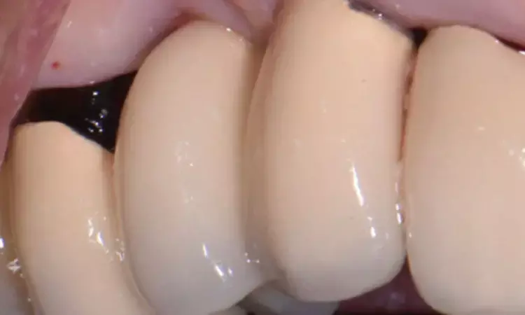 Teeth adjacent to implants in posterior sextants more liable to  develop  secondary  caries