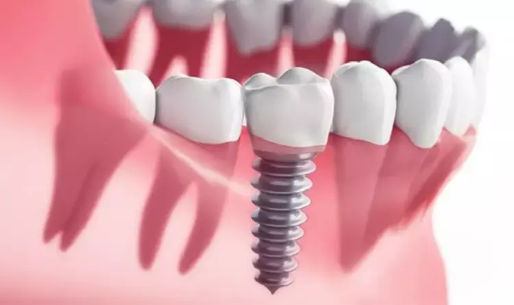 Dental implants-placed in grafted alveolar cleft sites can be successful