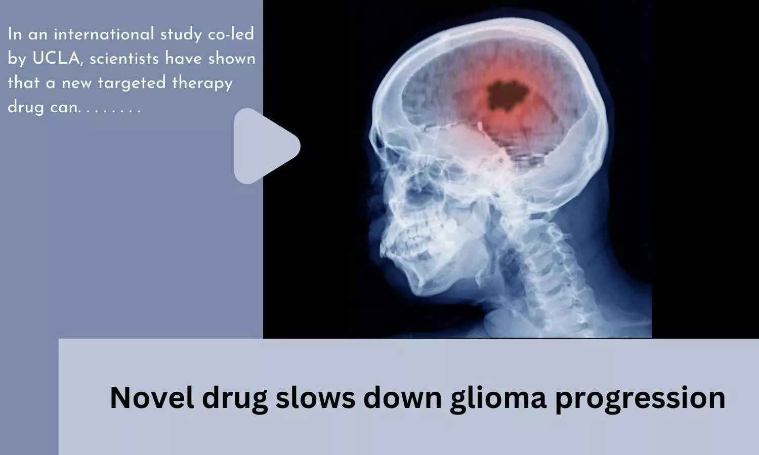 Novel drug slows down glioma progression