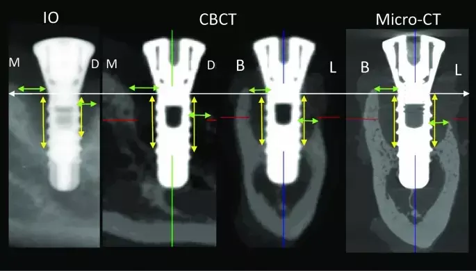 Cone beam computed tomography better for tintraoral radiography for evaluating Peri implant bone defect
