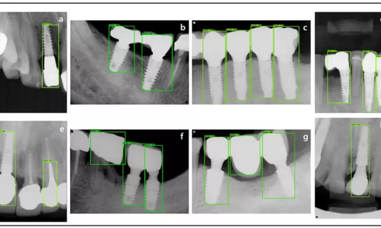 AI may identify dental implant systems accurately on radiography