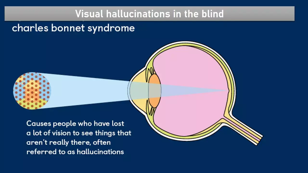 Blindness and hallucinations: Rare case of Charles Bonnet Syndrome linked to pituitary adenoma