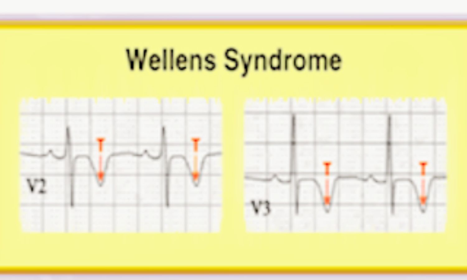 Wellens Syndrome Symptoms