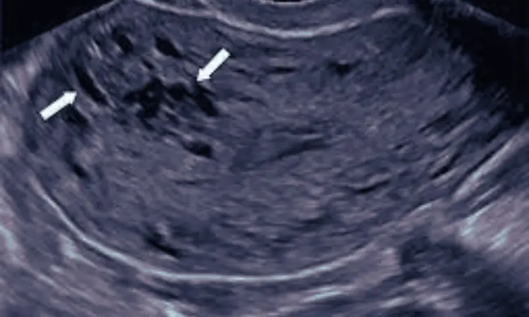 Sonography or pathology, which is more accurate for diagnosis of adenomyosis?