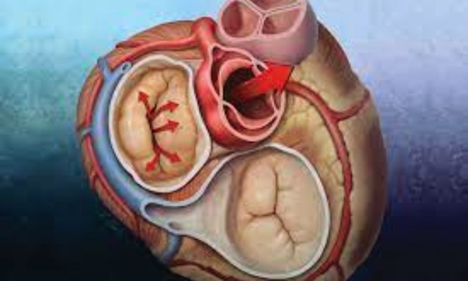 The HighLife TMVR System: CRM, 2026 Review Highlights 90 Percent Success in Mitral Regurgitation