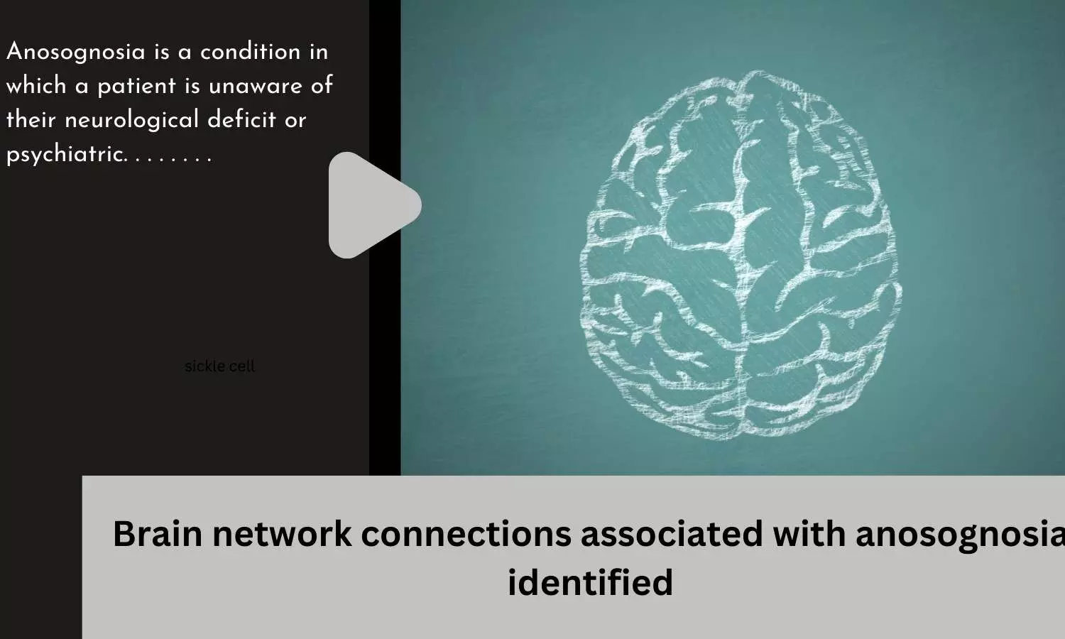 Brain network connections associated with anosognosia identified