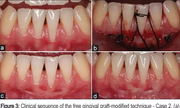 Keratinized tissue width augmentation enhances clinical and esthetic outcomes using FGG and LCC