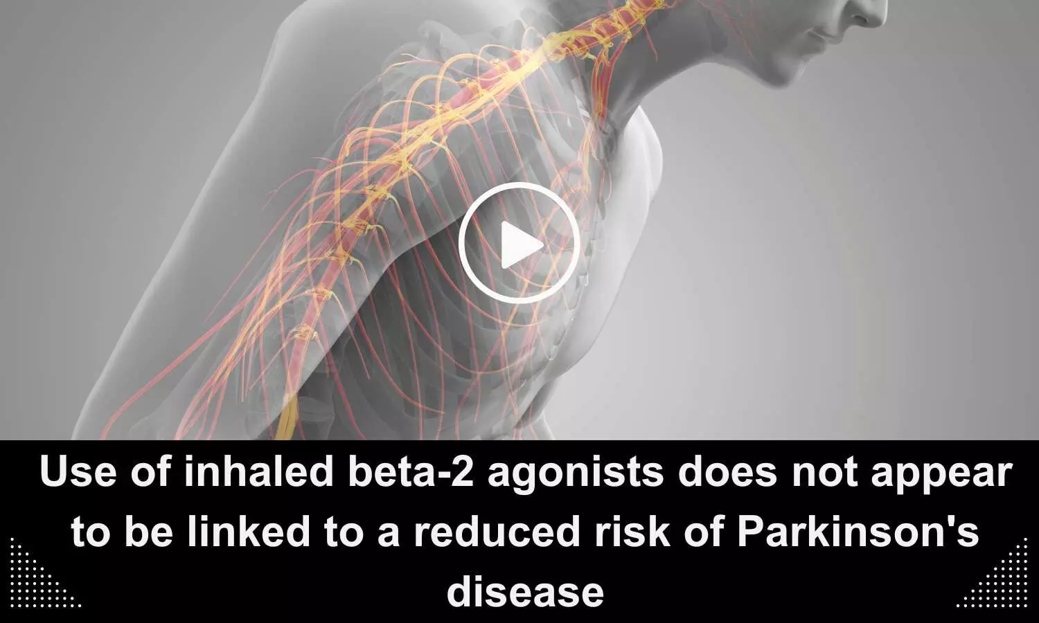 Use of inhaled beta-2 agonists  not linked to a reduced risk of Parkinsons disease.