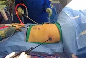 Postoperative pain and total analgesic use after serratus posterior superior intercostal plane block during video-assisted thoracoscopic surgery
