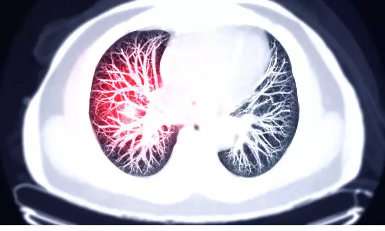 Concerning CT scans may cause unnecessary hospitalization for some pulmonary embolism patients