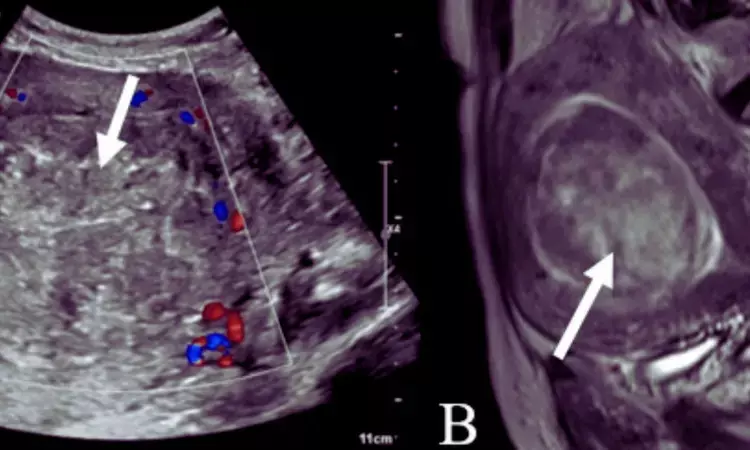 MRI accurate and effective technique for identifying causes of abnormal uterine bleeding