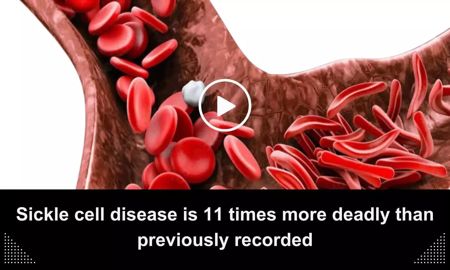 Sickle cell disease is 11 times more deadly than previously recorded