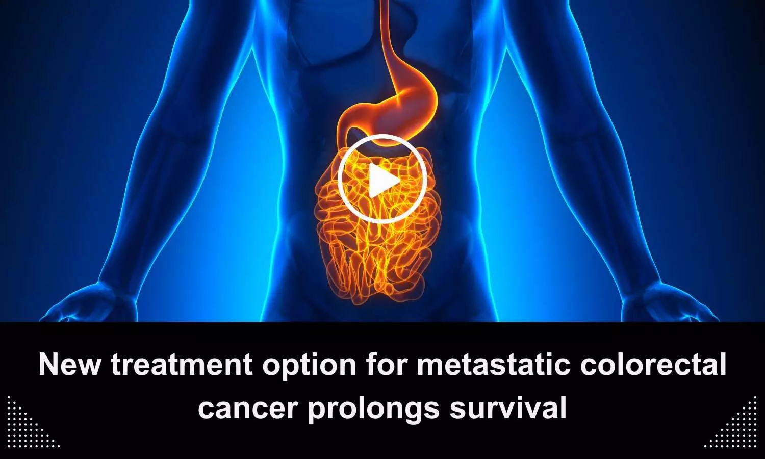 New treatment option for metastatic colorectal cancer prolongs survival