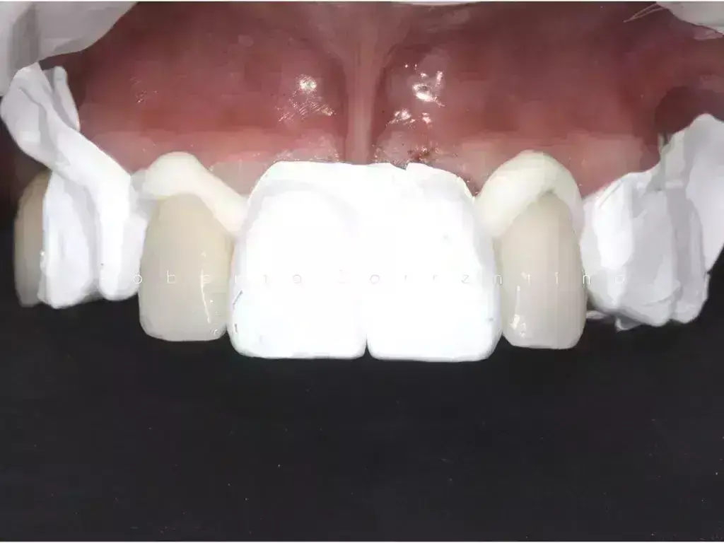 RMGIC non-inferior to SAC in terms of cementation success of zirconia restorations of both natural teeth and implants