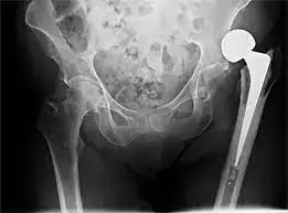 Higher rates of hemiarthroplasty dislocation observed in patients with preoperative CEA less than 38.5 & ADWR less than 34.5