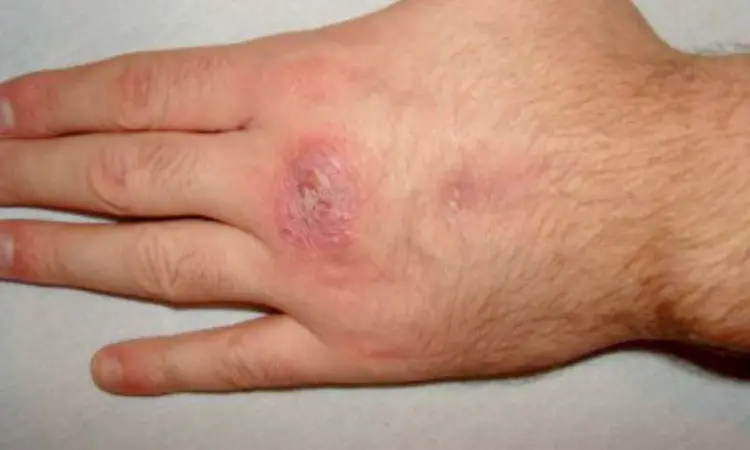 Treatment with JAK inhibitor for myelofibrosis leads to Mycobacterium marinum skin infection: A case report