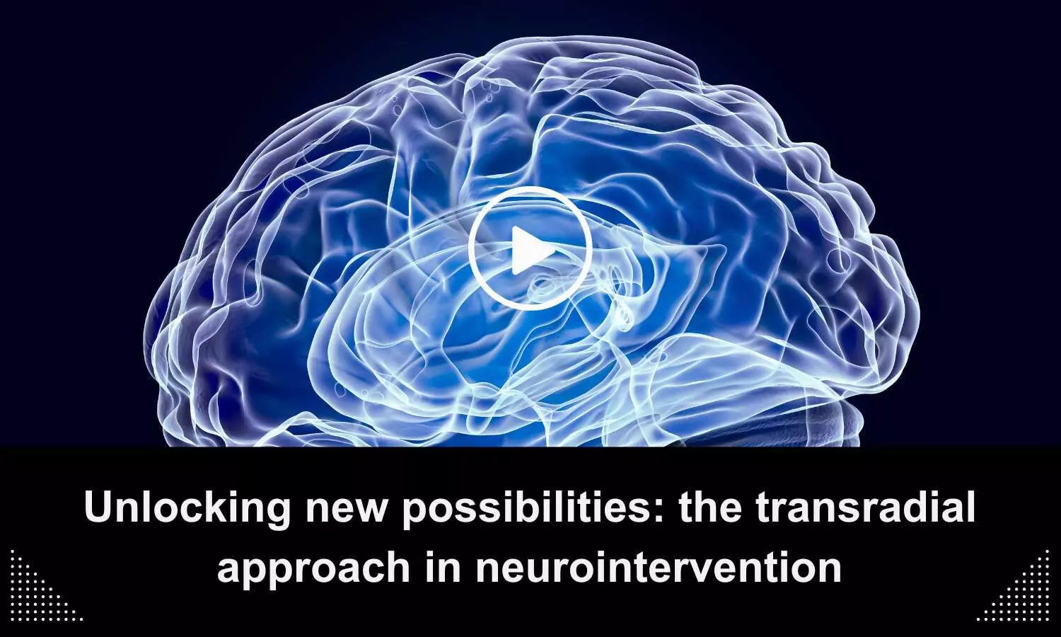 Unlocking New Possibilities: The Transradial Approach in Neurointervention