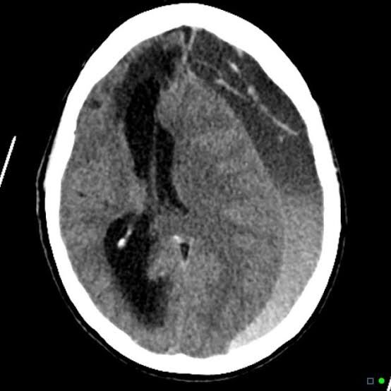 Dexamethasone versus Surgery for treatment of Chronic Subdural Hematoma