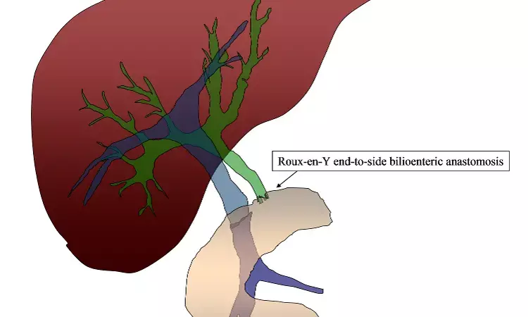 Roux-en-Y hepaticojejunostomy effective solution to biliary complications after living donor liver transplantation