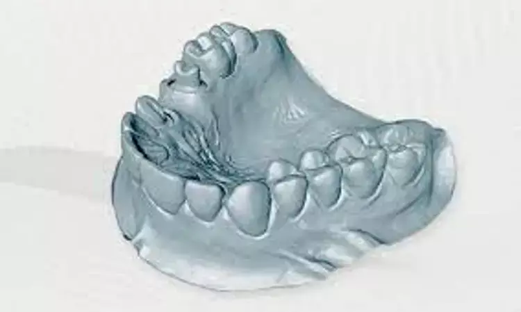 Cast or impression digitization more accurate than intraoral scanning for complete denture fabrication