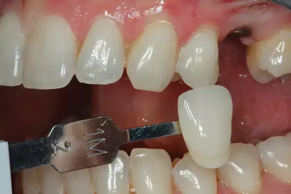 Monolithic Hybrid Disilicate abutment dependable treatment option for single restorations