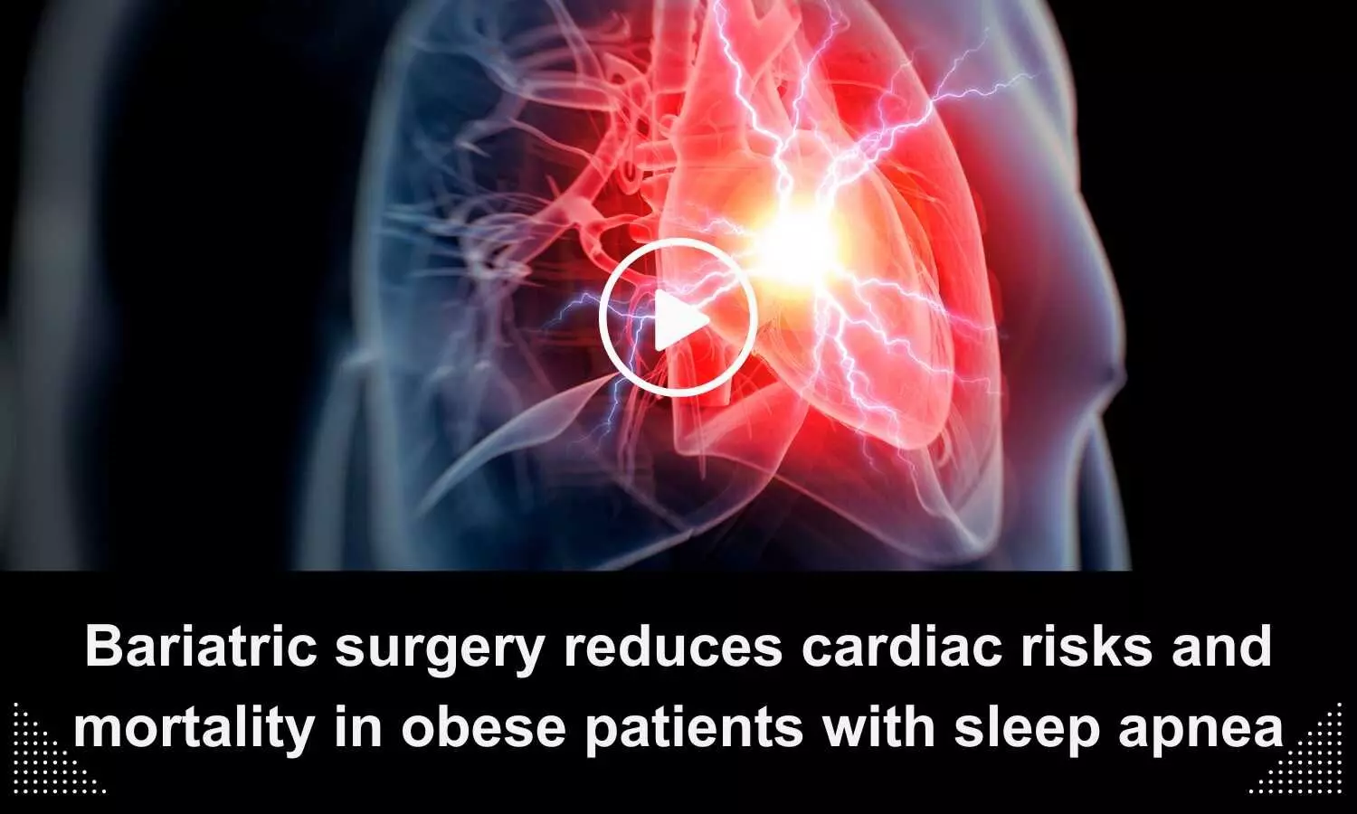 Bariatric surgery reduces cardiac risks and mortality in obese patients with sleep apnea