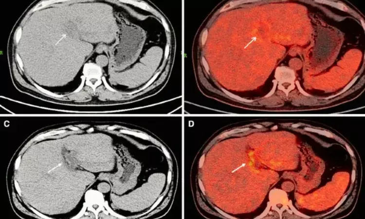 PET/CT valuable for distinguishing benign from malignant portal vein thrombosis in liver cirrhosis